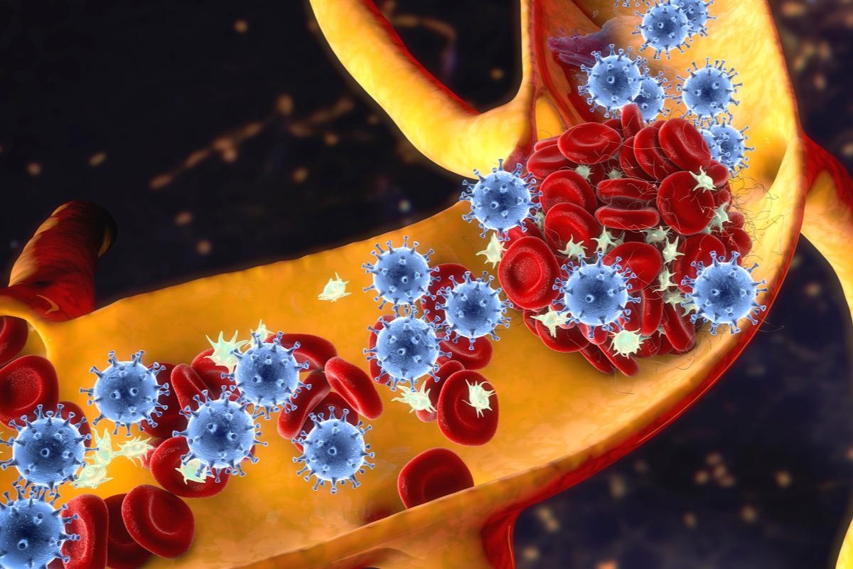 Study: Risks of deep vein thrombosis, pulmonary embolism, and bleeding after covid-19: nationwide self-controlled case series and matched cohort study. Image Credit: Kateryna Kon / Shutterstock.com