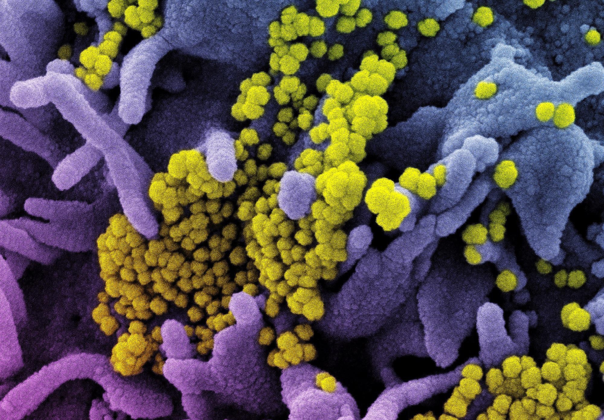 Study: Anti-SARS-CoV-2 Titers Predict the Severity of COVID-19. Image Credit: NIAID