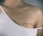 Study shows potential for eliminating surgery in a small subset of breast cancer patients