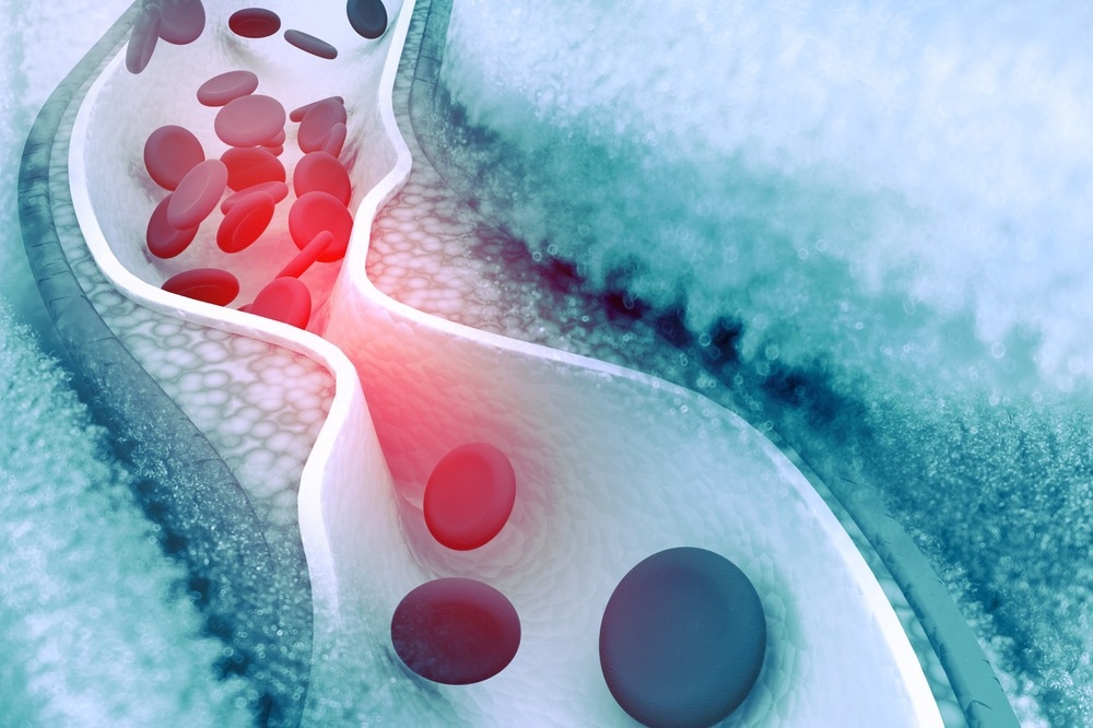 SStudy: Nanomedicines for cardiovascular disease. Image Credit: hywards / Shutterstock.com