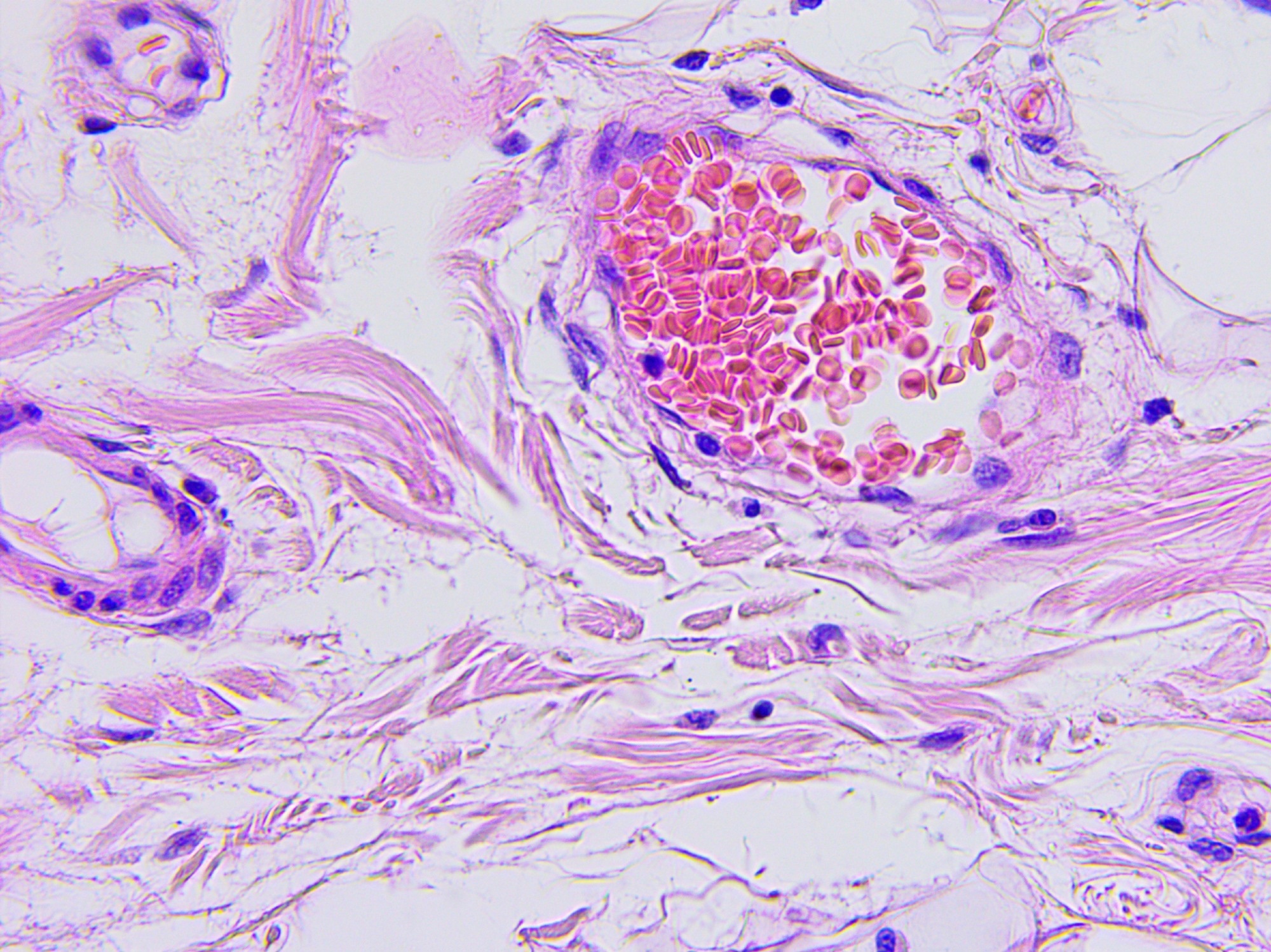 Phosphorylation and stabilization of EZH2 by DCAF1/VprBP trigger aberrant gene silencing in colon cancer