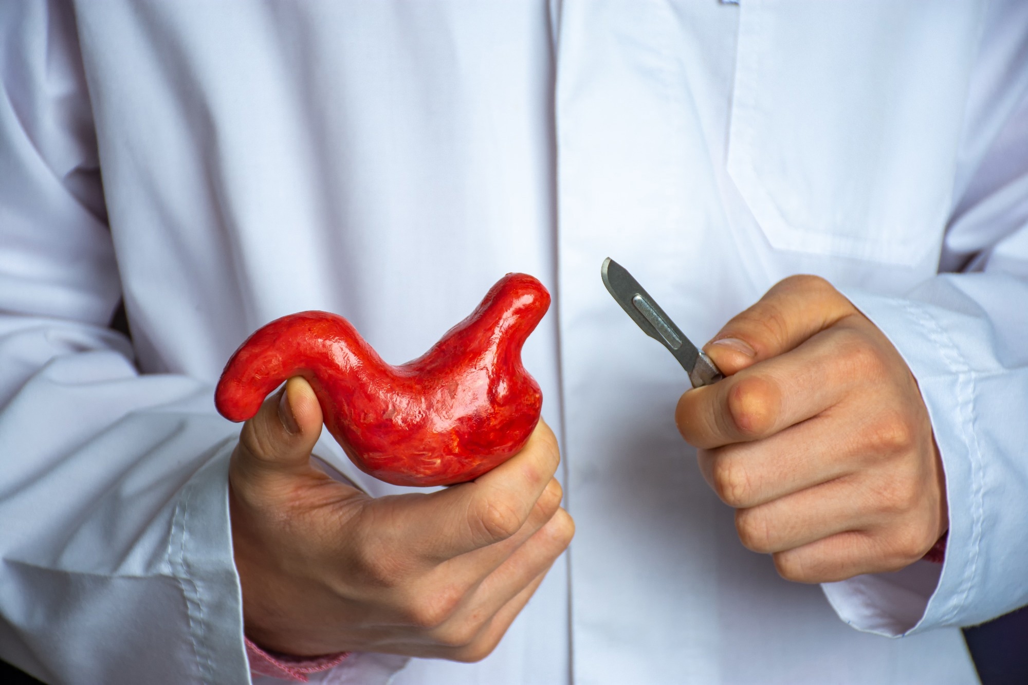 Study: Long-term effect of sleeve gastrectomy vs Roux-en-Y gastric bypass in people living with severe obesity: a phase III multicentre randomised controlled trial (SleeveBypass). Image Credit: Shidlovski/Shutterstock.com
