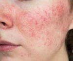 What natural compounds can help you manage your rosacea?