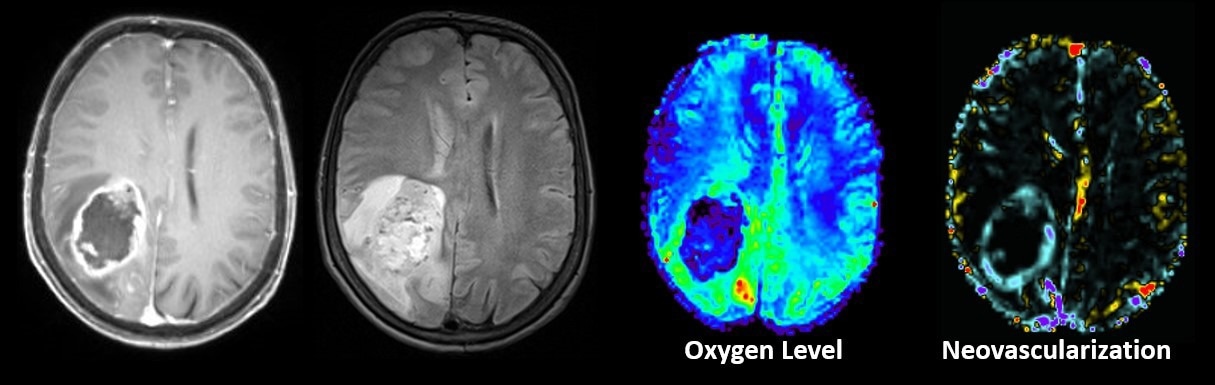 Machine learning enhances early detection of glioma mutations
