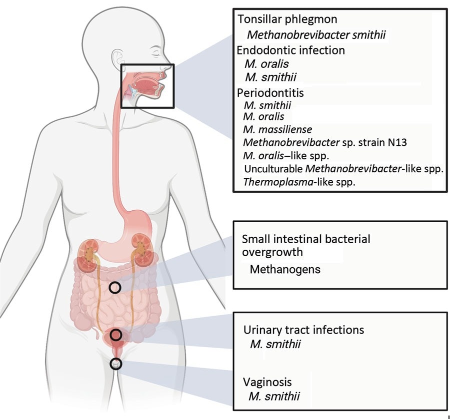 Infectious diseases in areas of the body in which archaea may have an effect. Figure created with BioRender (https://www.biorender.com).