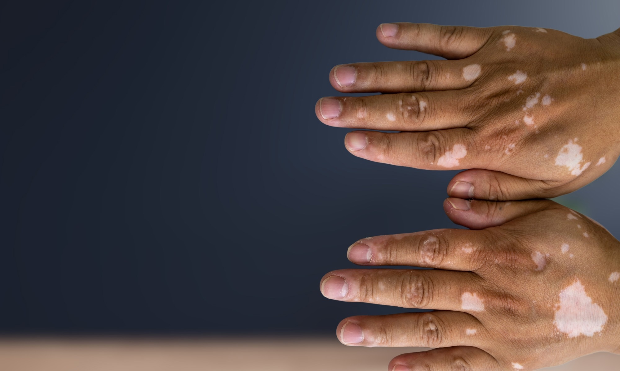 Study: Vitiligo is associated with an increased risk of cardiovascular diseases: a large-scale, propensity-matched, US-based retrospective study. Image Credit: Awishka215/Shutterstock.com