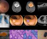 BiomedParse transforms biomedical image analysis with groundbreaking precision and scalability