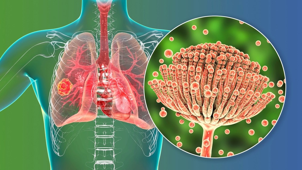 Study: Mortality in chronic pulmonary aspergillosis: a systematic review and individual patient data meta-analysis. Image Credit: Kateryna Kon/Shutterstock.com