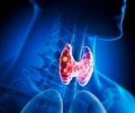 GLP-1RA initiation linked to new thyroid cancer diagnoses