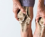 Weight-loss lifestyle changes slow bone loss in older adults