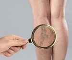 Varicose veins increase your risk of dementia, study finds