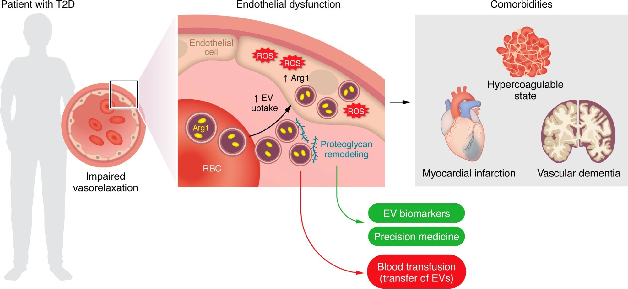 EVs derived from RBCs of patients with T2D are taken up by the endothelium and impair endothelium-dependent relaxation via an EV-mediated transfer of the prooxidant enzyme Arg1. Proteoglycan remodeling is a main event fostering EV uptake and may provide targets that could serve as disease biomarkers and/or personalized therapies for blocking EV uptake. RBC-EVs are also implicated in diabetes-related comorbidities, namely hypercoagulability, myocardial infarction, and vascular dementia. Blood transfusion from patients with cardiovascular risk factors represents a potential issue given the transfer of RBC-EVs and subsequent endothelial dysfunction in the recipient patient.