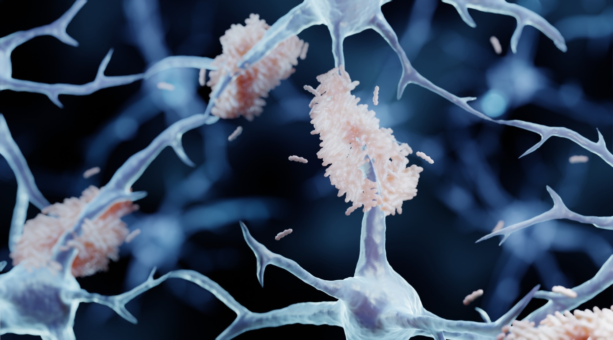 Study: A plasma biomarker panel for detecting early amyloid-β accumulation and its changes in middle-aged cognitively unimpaired individuals at risk for Alzheimer’s disease. Image Credit: ART-ur / Shutterstock