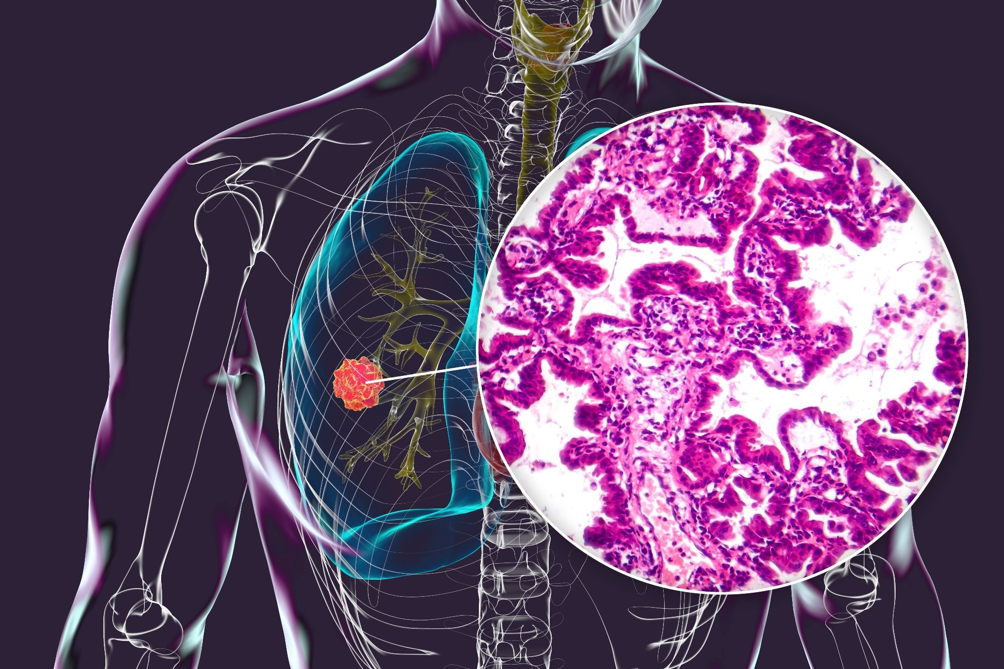 A human body with transparent skin showcasing lung cancer, 3D illustration complemented by a light micrograph of the lung adenocarcinoma