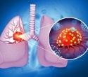 Allergies linked to lower lung cancer risk, new study finds