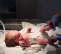 High-dose vitamin D strengthens bones in very low birth weight infants