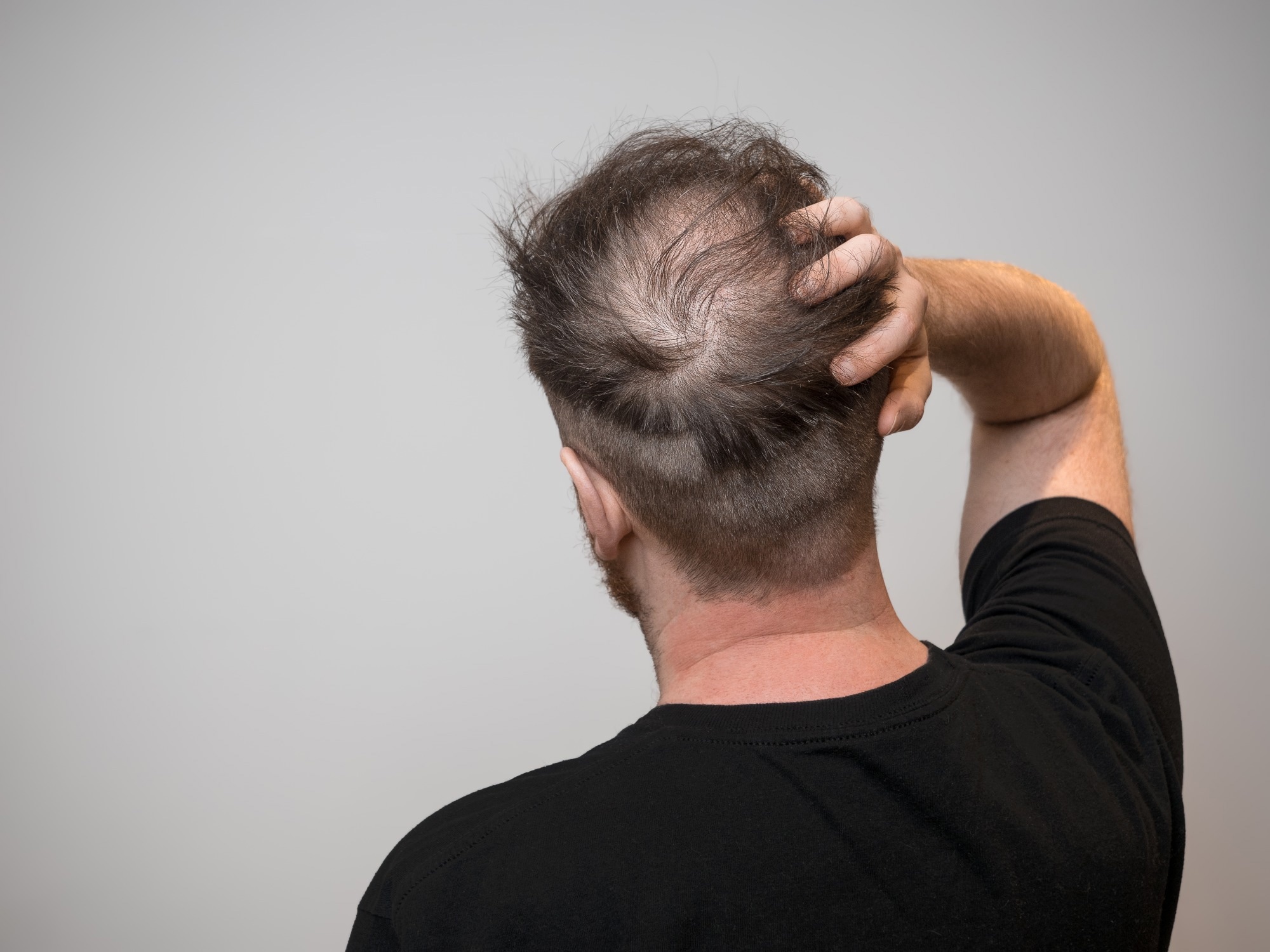 Assessing the relationship between dietary factors and hair health: A systematic review. Image Credit: Chris Curry / Shutterstock