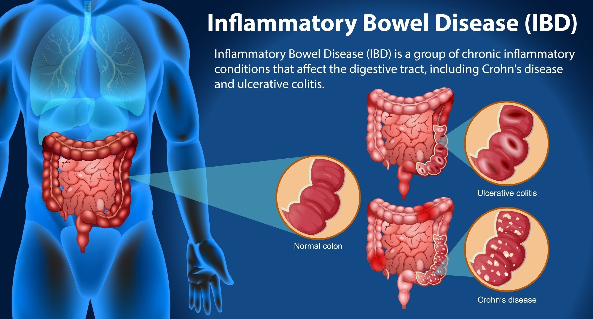 Review: Systems biology to unravel Western diet-associated triggers in inflammatory bowel disease. Image Credit: BlueRingMedia / Shutterstock