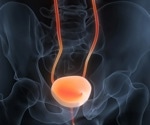Urine cfDNA patterns emerge as a promising tool for diagnosing bladder cancer