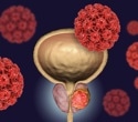 Breakthrough combo therapy lowers death risk in recurrent prostate cancer