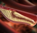 CAR T cell therapy could be a highly effective tool against atherosclerosis