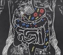 New insights into the role of diet and microbiome in gastric cancer