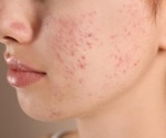 Study reveals widespread unrecognized acne among 35-year-old Finnish women