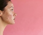 More research needed to determine if laser therapy is an effective treatment for acne