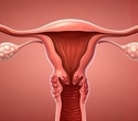 Women with endometriosis-associated infertility are more likely to become pregnant, study reveals