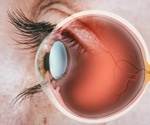 AI-based glaucoma screening could revolutionize eye health